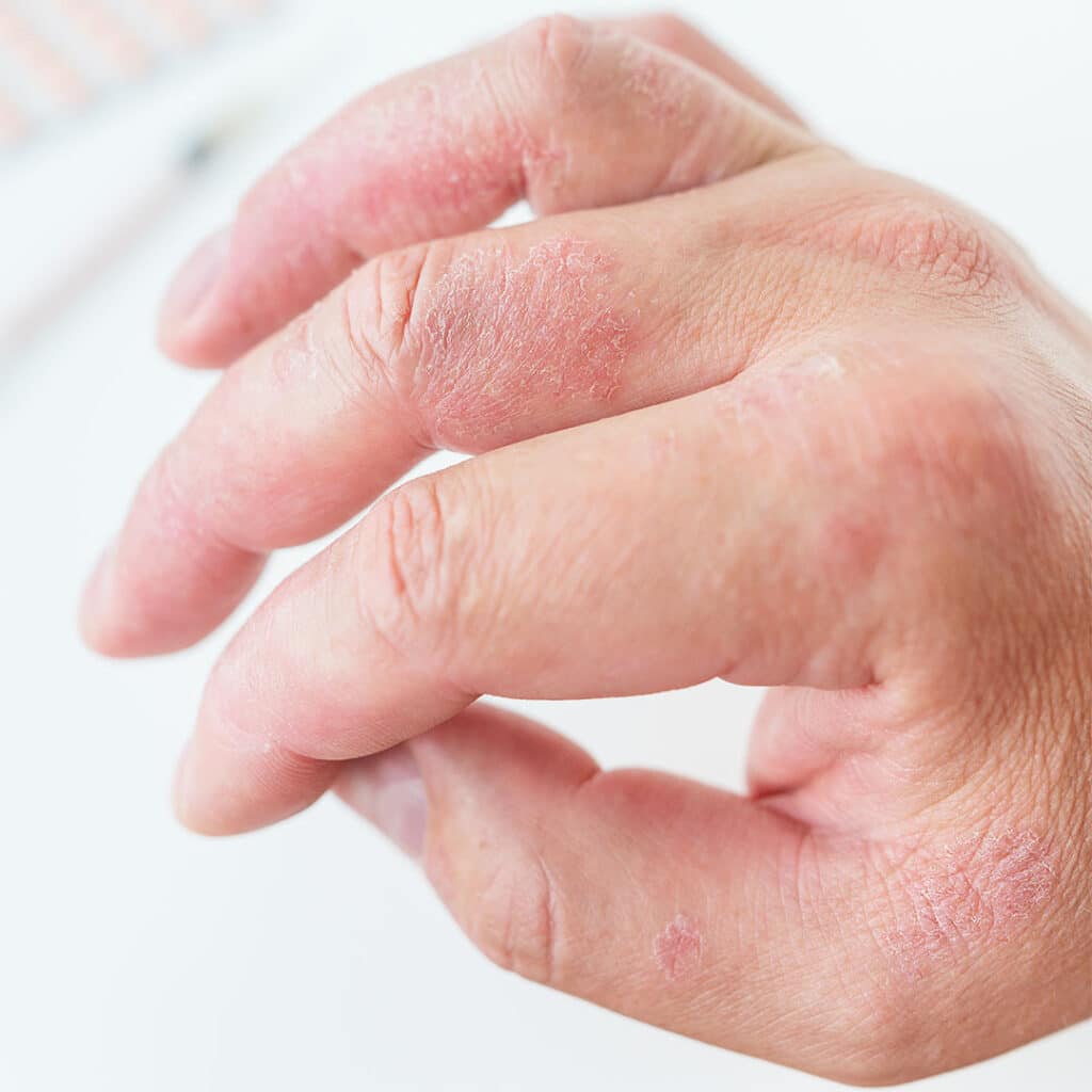 RACGP - An itchy rash on the fingertips: a case study