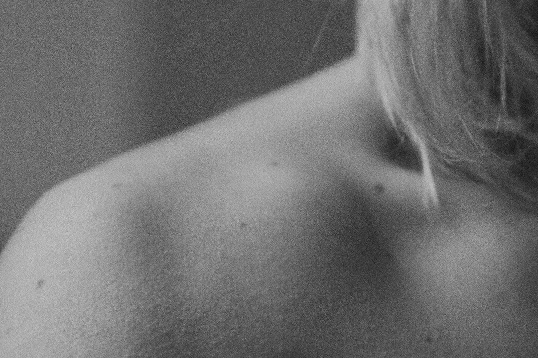 Photo atrophic scars