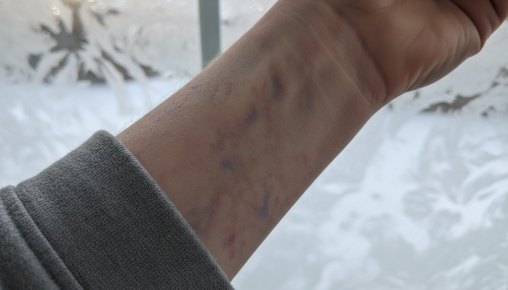 benign mottled skin causes benign mottled skin causes